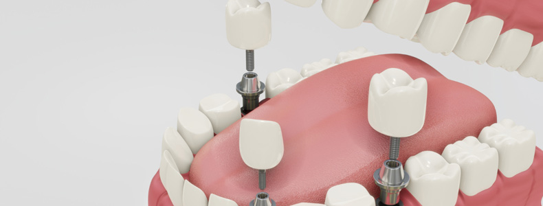 İmplant Tedavisi 2 implant yapılır kırmız dilin ve diş etlerinin çevresindeki beyaz dişlerim yanında
