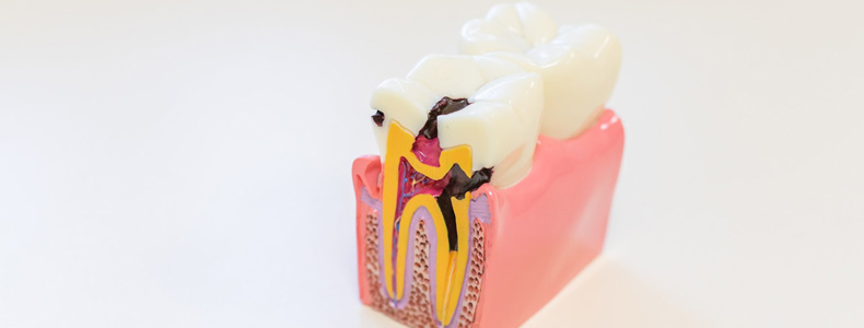 kanal tedavisi ve endodonti tedavisi yapılır beyaz zemin üzerinde pembe diş eti üzerindeki dişte