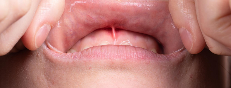 Diş Eti Hastalıkları Tedavisi (Periodontoloji) yapılır iki eli ile dudaklarını açmış hastanın diş etlerine.