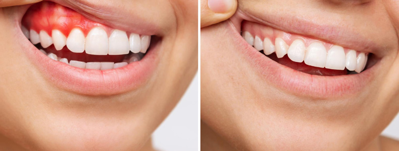 Diş Eti Hastalıkları Tedavisi (Periodontoloji) yapılır eli ile dudaklarını kaldırmış hastanın diş etlerinde.