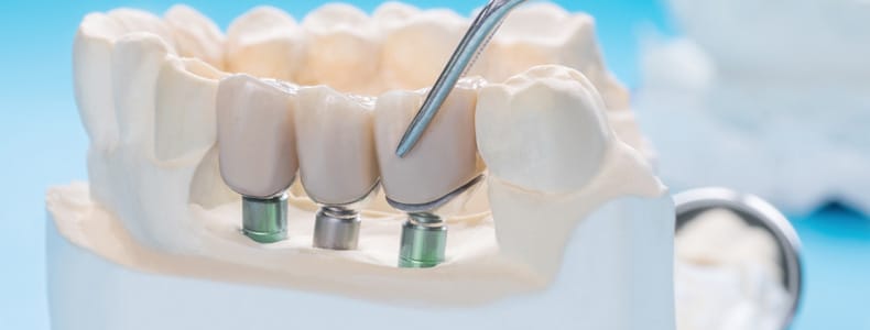 14 Soruda İmplant Diş Tedavisi Hakkında Merak Edilenler 4 implant diş maketi bulunur mavi masanın üzerinde.