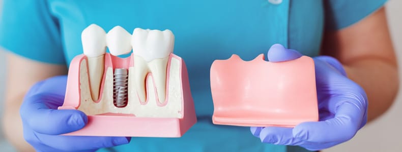 14 Soruda İmplant Diş Tedavisi Hakkında Merak Edilenler 7 İmplant diş maketi bulunur ellerinde mavi eldiven bulunan doktorun ellerinde.