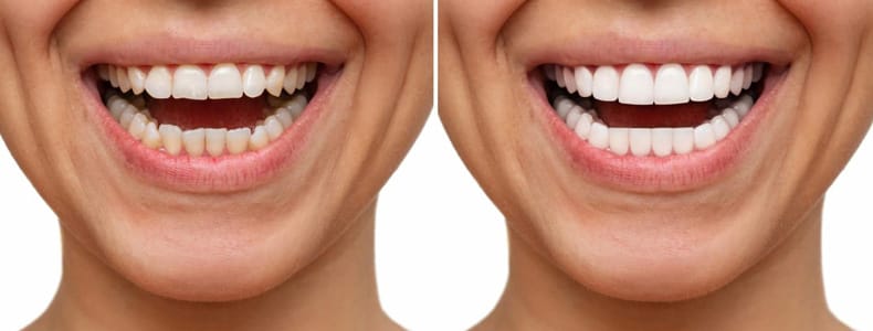 12 Soruda Zirkonyum Diş Kaplama Fiyatları ve Tedavisi 7 Zirkonyum diş kaplama öncesi ve sonrası gösterilir hastanın yüzünde.