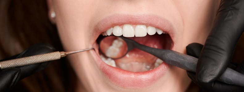 20'lik diş tedavisi yapılır ağzını açmış olan kadın hastanın dişlerinde.