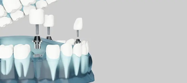 İmplant Çeşitleri Nelerdir? 9 İmplant Diş Çeşidi ve Özellikleri Nelerdir? 7 İmplant çeşitleri ile tedavi şekli gösterilir örnek diş röntgen görselinin üzerinde.