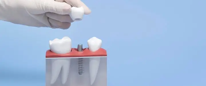 İmplant çeşitleri gösterilir maket diş üzerinde.