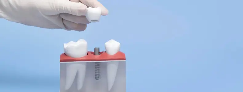 İmplant Çeşitleri Nelerdir? 9 İmplant Diş Çeşidi ve Özellikleri Nelerdir? 4 İmplant çeşitleri gösterilir maket diş üzerinde.