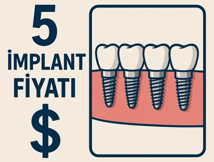 5 adet dental implant ve fiyat simgesi içeren çizim – diş hekimliği ve implant tedavisi temalı