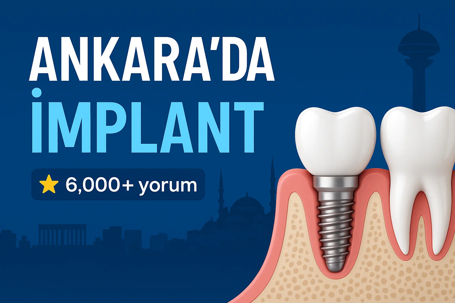 ankarada implant