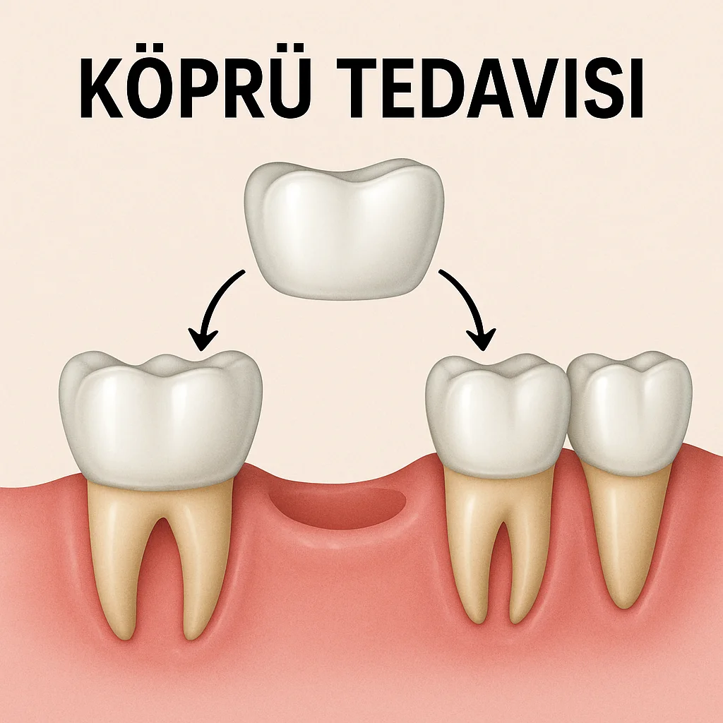 Köprü Tedavisi Nedir? 2025’te Diş Kaybına Etkili Çözüm 5 kopru tedavisi