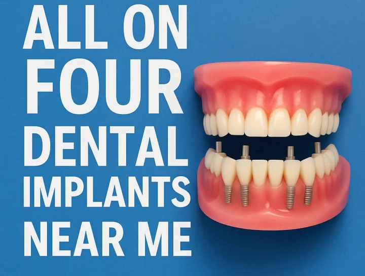 all on four dental implants near me