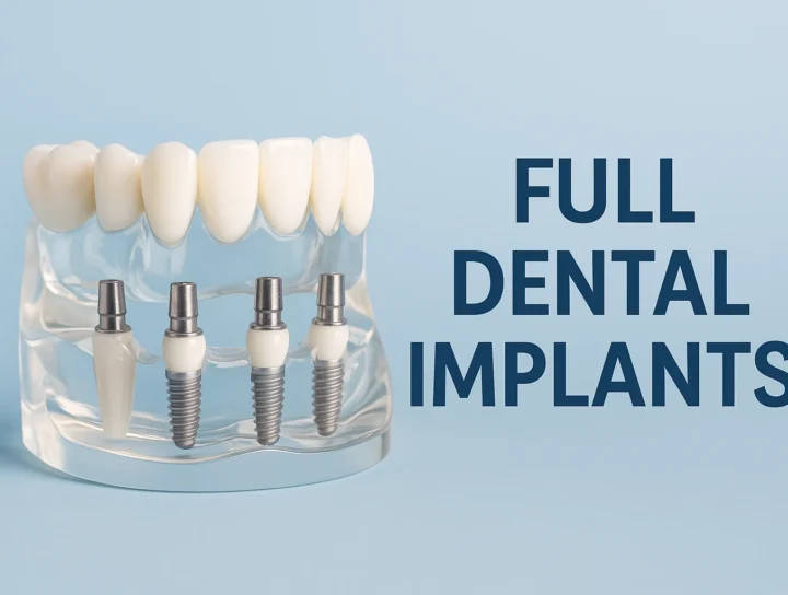 Full Dental Implants: Comprehensive Guide for a Perfect Smile 8 full dental implants
