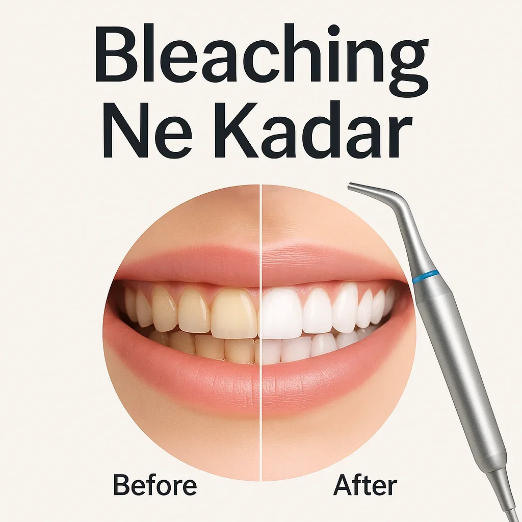 Bleaching Ne Kadar? 2025 Güncel Diş Beyazlatma Fiyatları 5 bleaching ne kadar