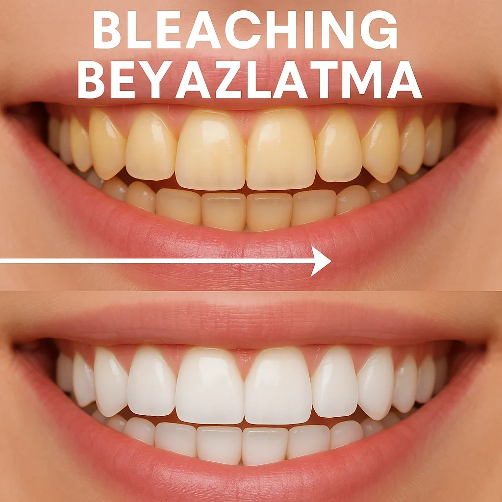 Bleaching Beyazlatma 2025: Diş Beyazlatmada Güncel Yöntemler 5 bleaching beyazlatma