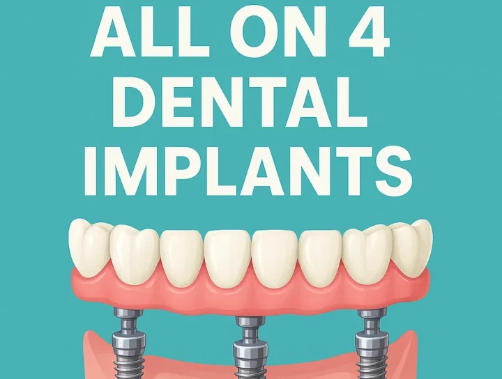 cheap all on 4 dental implants