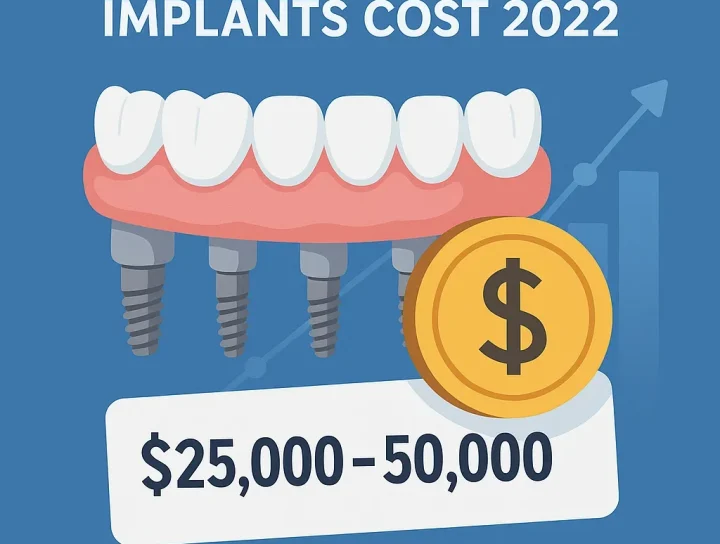 full mouth dental implants cost 2022