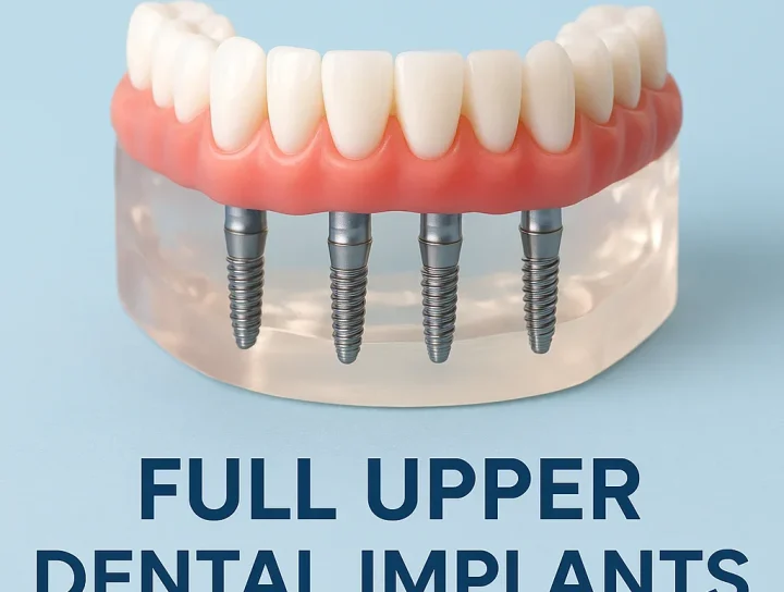 Full Upper Dental Implants – Everything You Need to Know 4 full upper dental implants