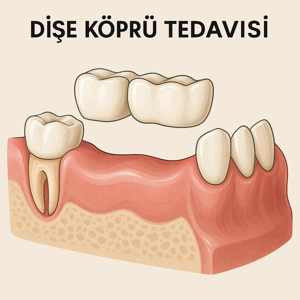 Dişe Köprü Tedavisi Nedir? Tüm Detaylarıyla Açıklama 5 dise kopru tedavisi