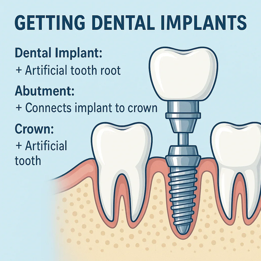Getting Dental Implants: Everything You Should Know in 2025 5 getting dental implants