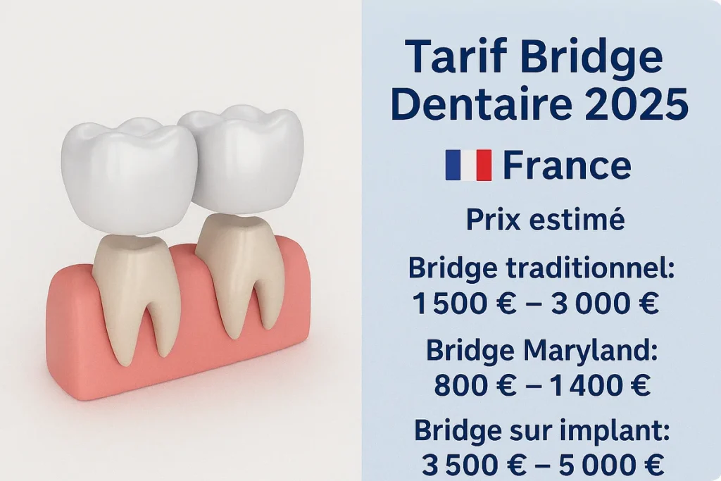 Tarif bridge dentaire 2025 : tout savoir 4 tarif bridge dentaire 2025