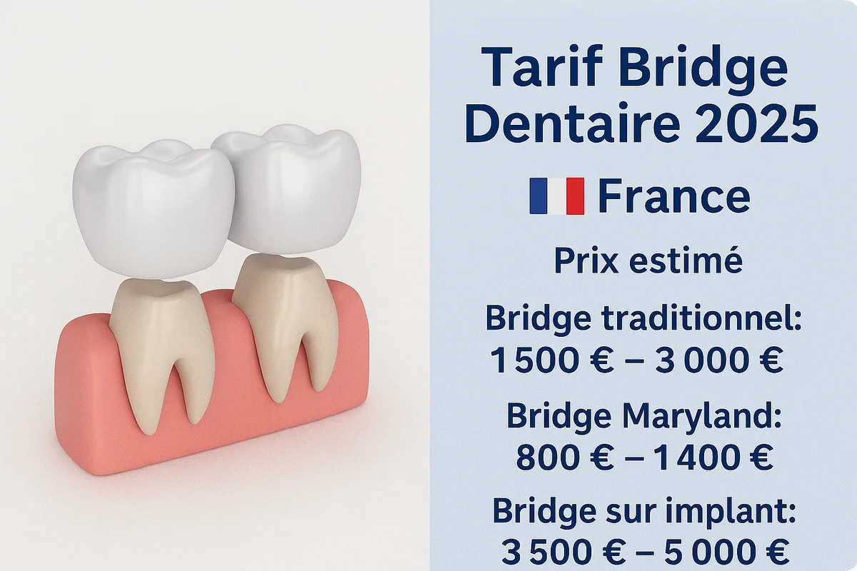 Tarif bridge dentaire 2025 : tout savoir 5 tarif bridge dentaire 2025