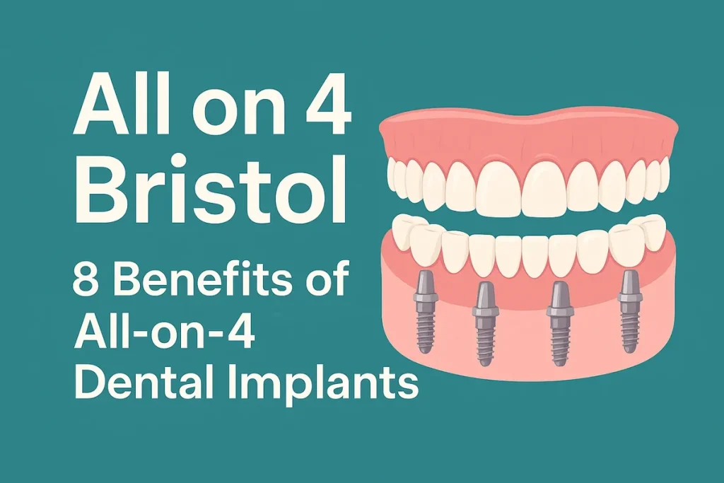 All on 4 Bristol: Kalıcı Gülüş İçin Modern Diş İmplantı Çözümü 4 all on 4 bristol