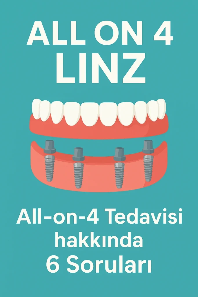 All on 4 Linz: Modern Diş İmplant Teknolojisiyle Eksiksiz Gülüş 4 all on 4 linz