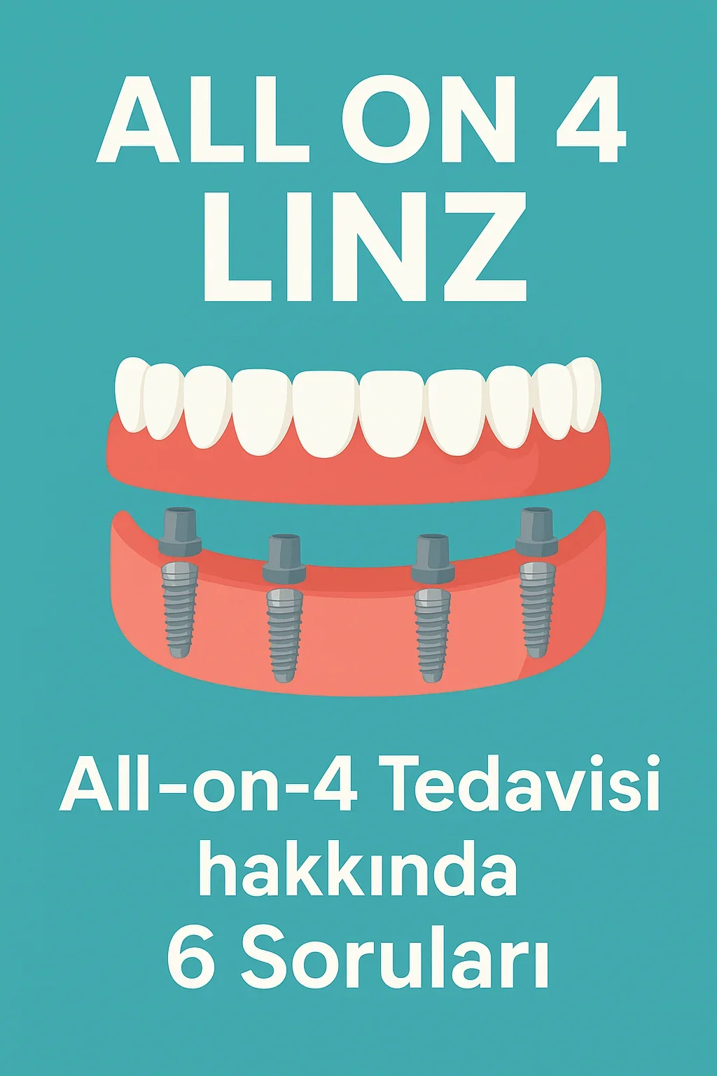 All on 4 Linz: Modern Diş İmplant Teknolojisiyle Eksiksiz Gülüş 5 all on 4 linz