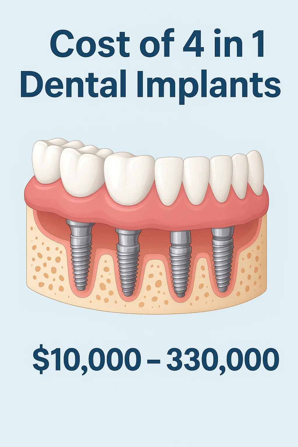 Understanding the Cost of 4 in 1 Dental Implants: Full Guide 2025 5 cost of 4 in 1 dental implants