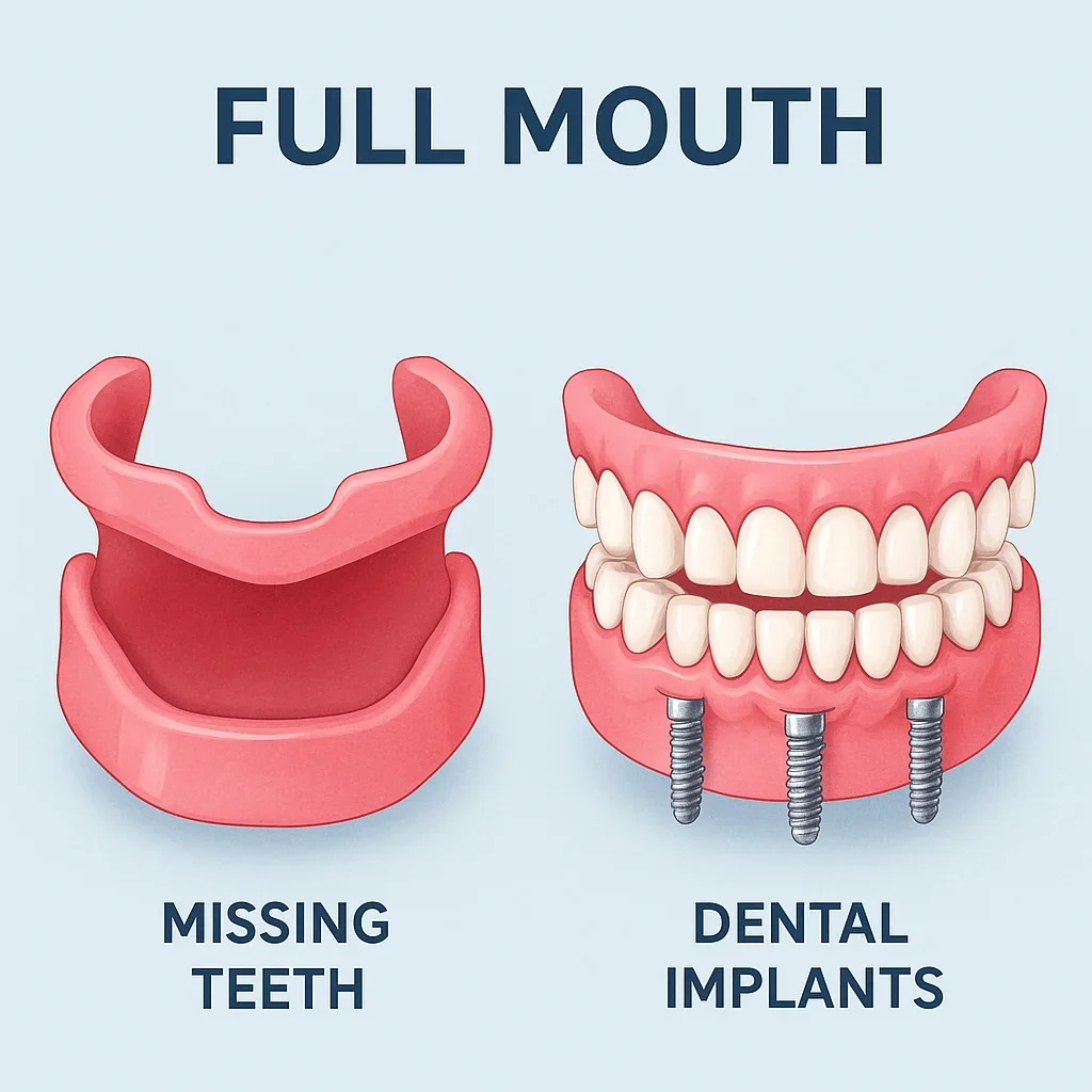 Full Mouth Dental Implants: Everything You Need to Know 5 full mouth