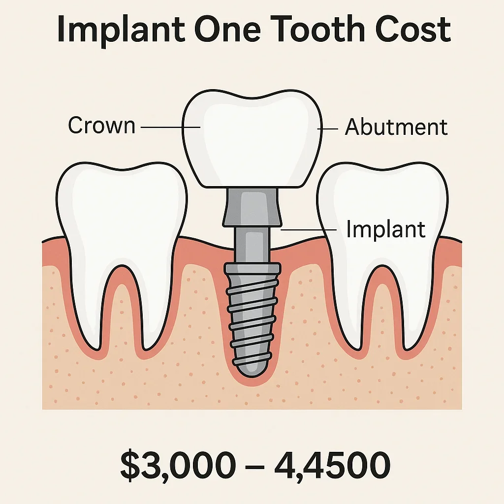 Implant One Tooth Cost: Complete 2025 Guide 🦷 5 implant one tooth cost