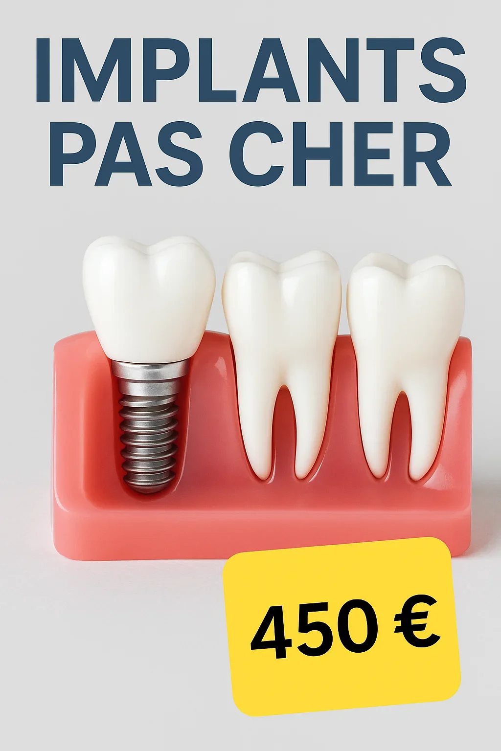 Implants pas cher : guide complet pour un sourire abordable 5 implants pas cher