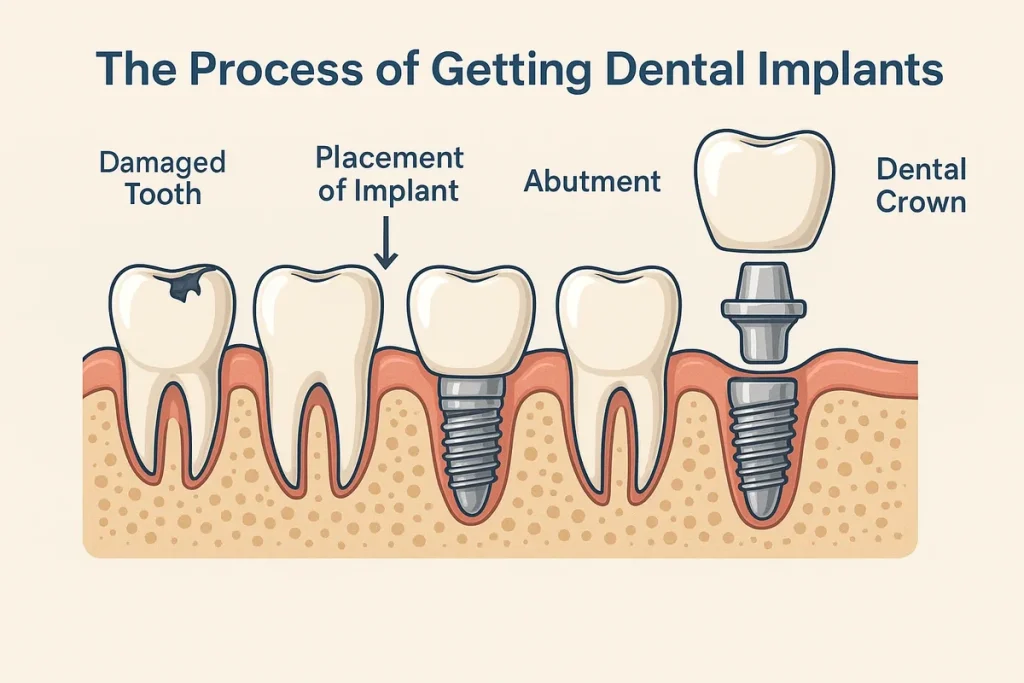 The Process of Getting Dental Implants: Step-by-Step Guide 🦷 4 the process of getting dental implants