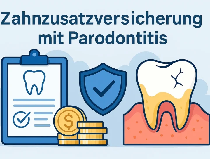 Zahnzusatzversicherung mit Parodontitis – das sollten Sie wissen 4 zahnzusatzversicherung mit parodontitis