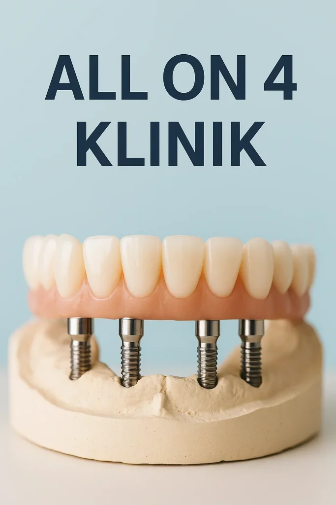All on 4 Klinik Nedir? Diş Tedavisinde Yenilikçi Yaklaşım 4 all on 4 klinik