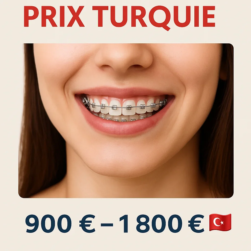 Appareil dentaire prix Turquie – tout ce qu’il faut savoir 🇹🇷 5 appareil dentaire prix turquie