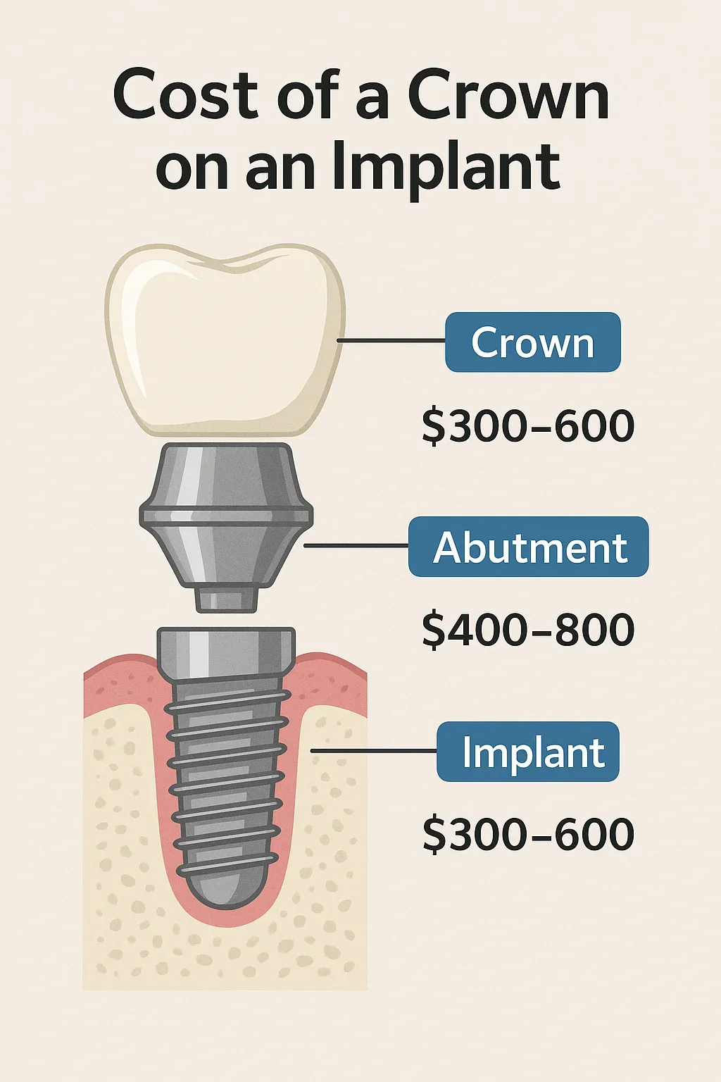 Understanding the True Cost of a Crown on an Implant 5 cost of a crown on an implant