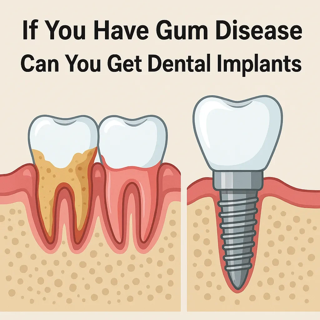 If You Have Gum Disease Can You Get Dental Implants? 5 if you have gum disease can you get dental implants