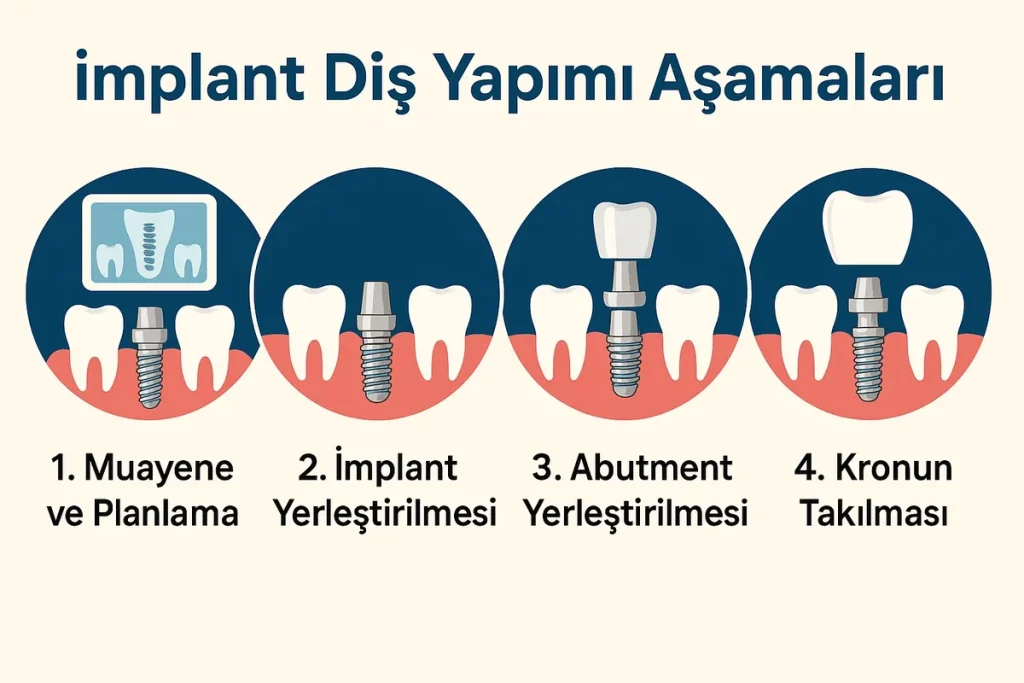 implant dis yapimi asamalari Nelerdir? Tam Kapsamlı Rehber 4 implant dis yapimi asamalari