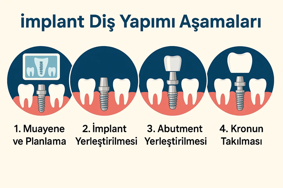 implant dis yapimi asamalari Nelerdir? Tam Kapsamlı Rehber 5 implant dis yapimi asamalari