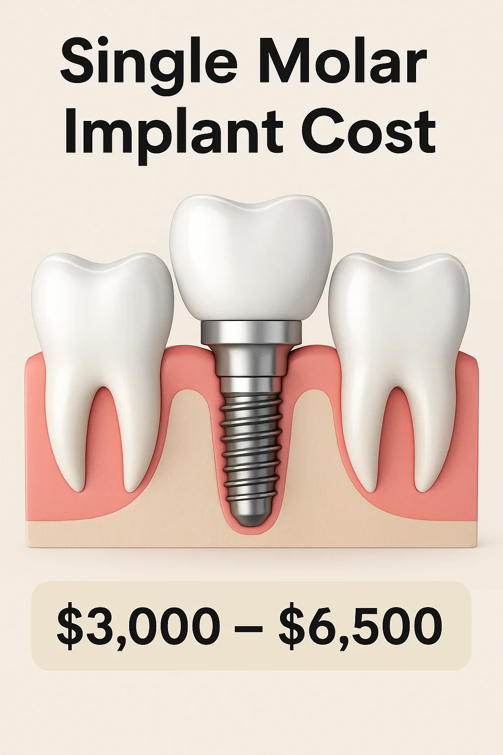 Single Molar Implant Cost: 2025 Complete Guide 5 single molar implant cost