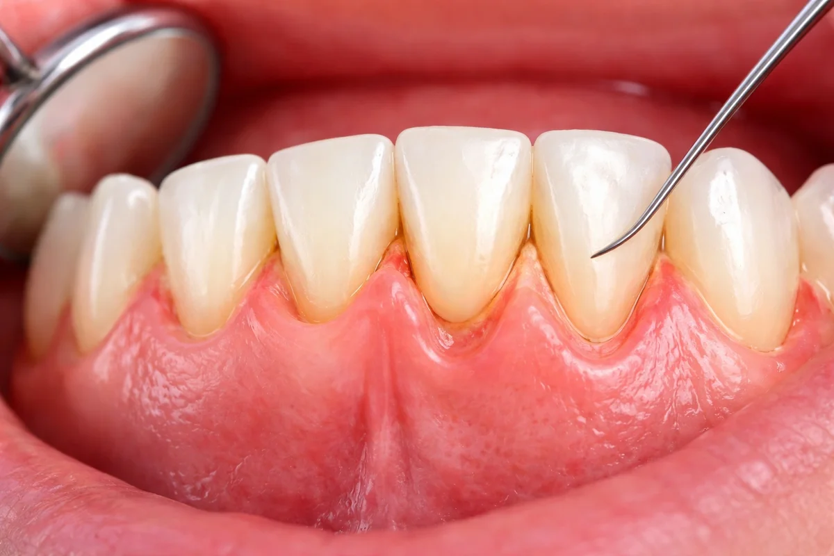 Diş Eti Çekilmesine Nedir ve Neden Bu Kadar Önemlidir? 5 dis eti cekilmesine