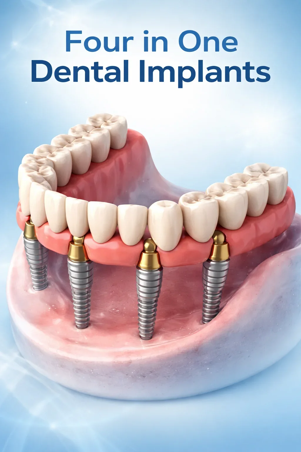 Four in One Dental Implants: Complete Guide for Patients 5 four in one dental implants