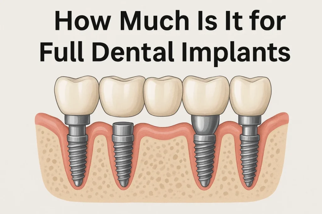 How Much Is It for Full Dental Implants? 4 how much is it for full dental implants