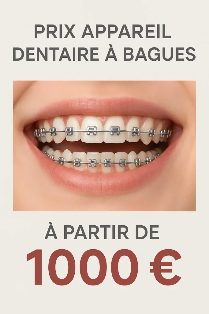 Prix appareil dentaire bague : guide complet 2025 4 prix appareil dentaire bague