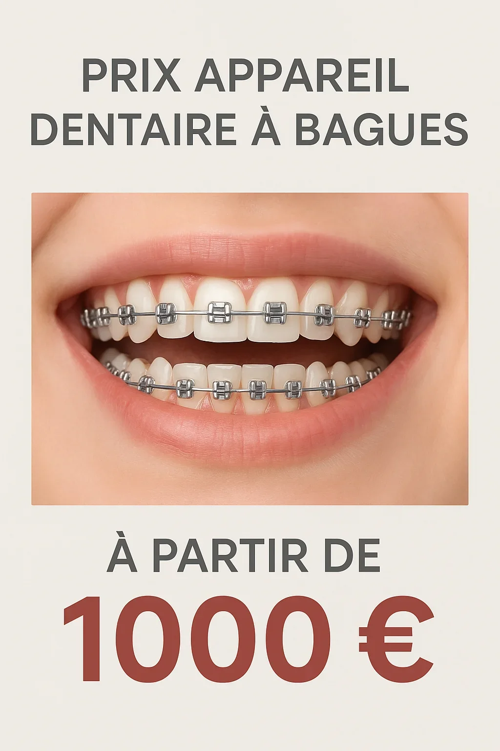Prix appareil dentaire bague : guide complet 2025 5 prix appareil dentaire bague