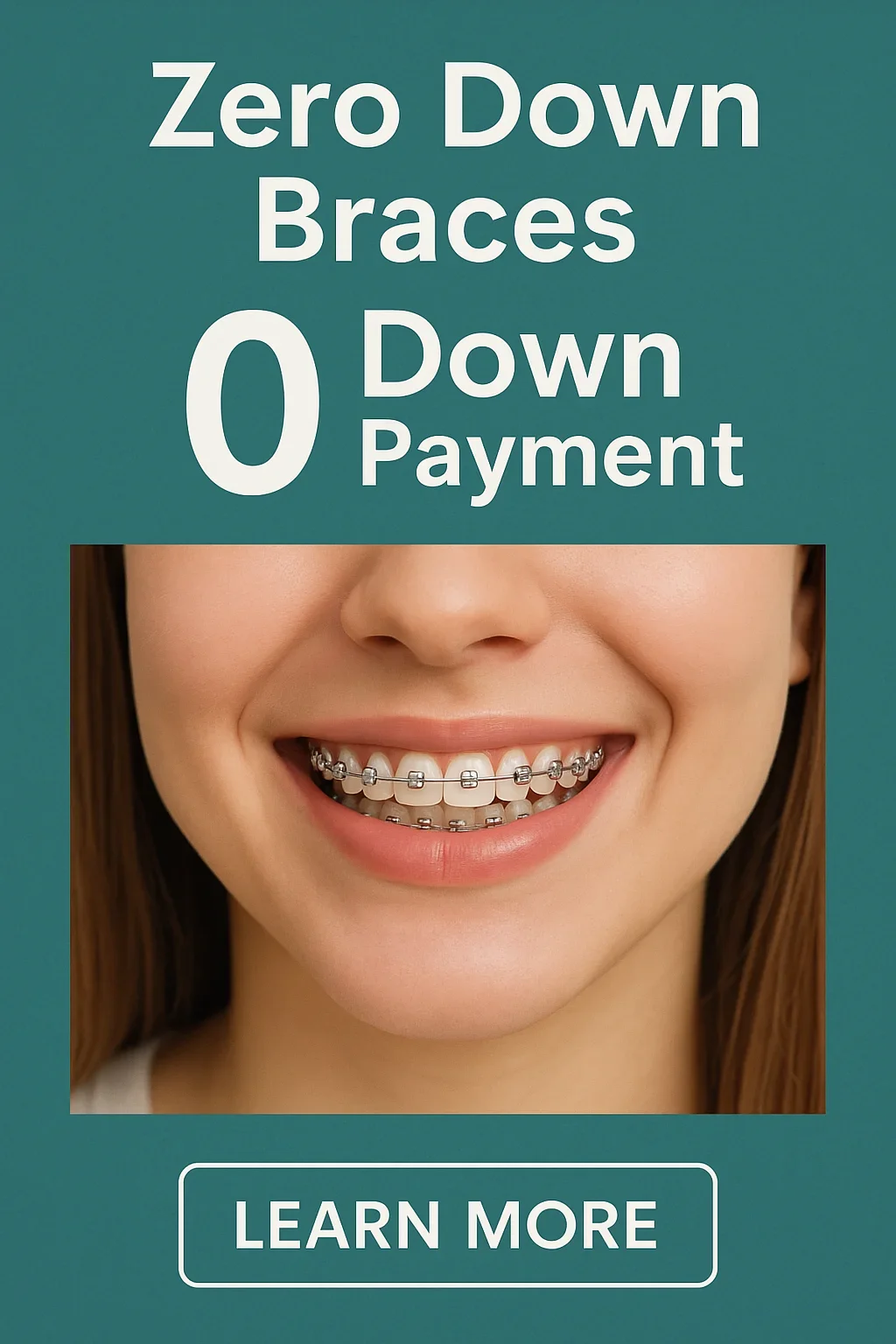 Zero Down Braces: Everything You Need to Know Before Starting Treatment 5 zero down braces