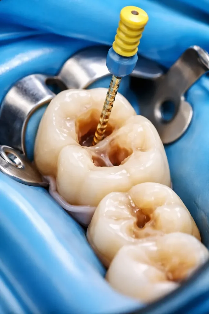 Endodontik Diş Nedir ve Neden Uygulanır? 4 endodontik dis