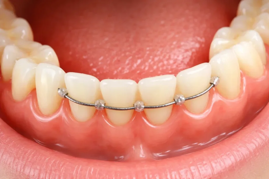 Lower Permanent Retainer: Everything You Need to Know 4 lower permanent retainer