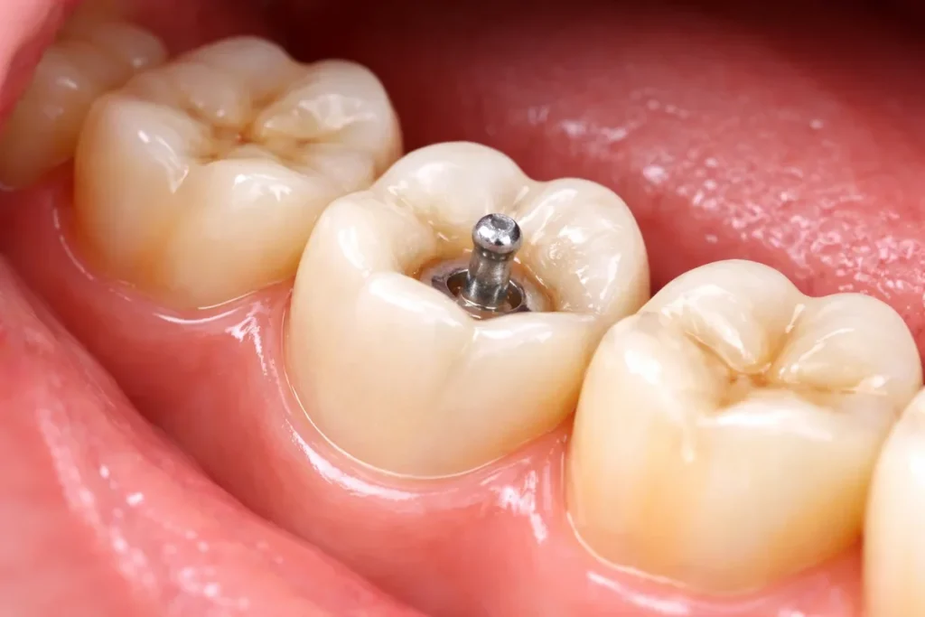 Sprig Crowns: A Complete Guide to This Dental Crown Option 4 sprig crowns